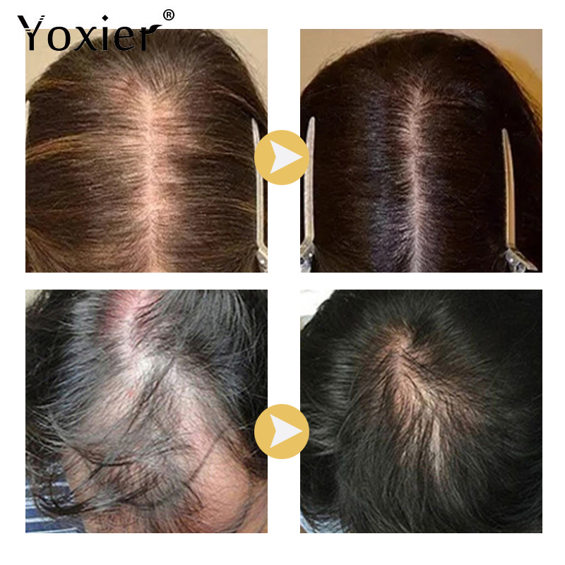 Sérum à croissance Intensive p - Hair Care For Hair Loss avis et prix
