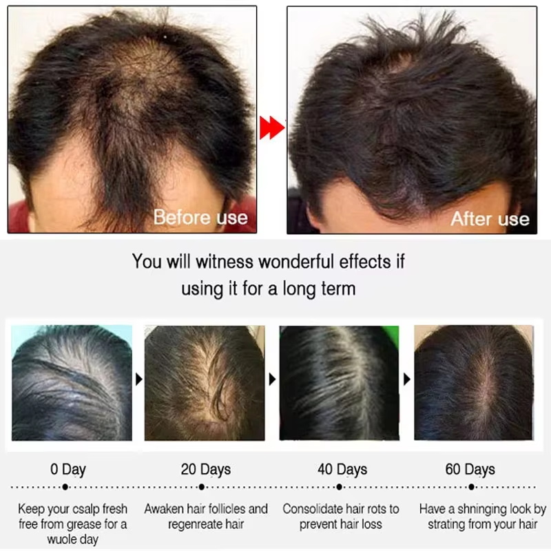 Spray de croissance rapide pou - Hair Care For Hair Loss avis et prix
